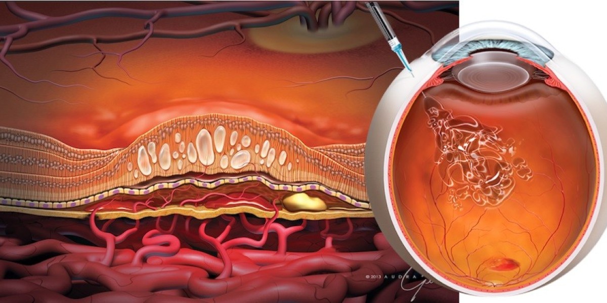 Global Retinal Drugs Market Research Demonstrates the Industry to Reach USD 9.5 Billion by 2032
