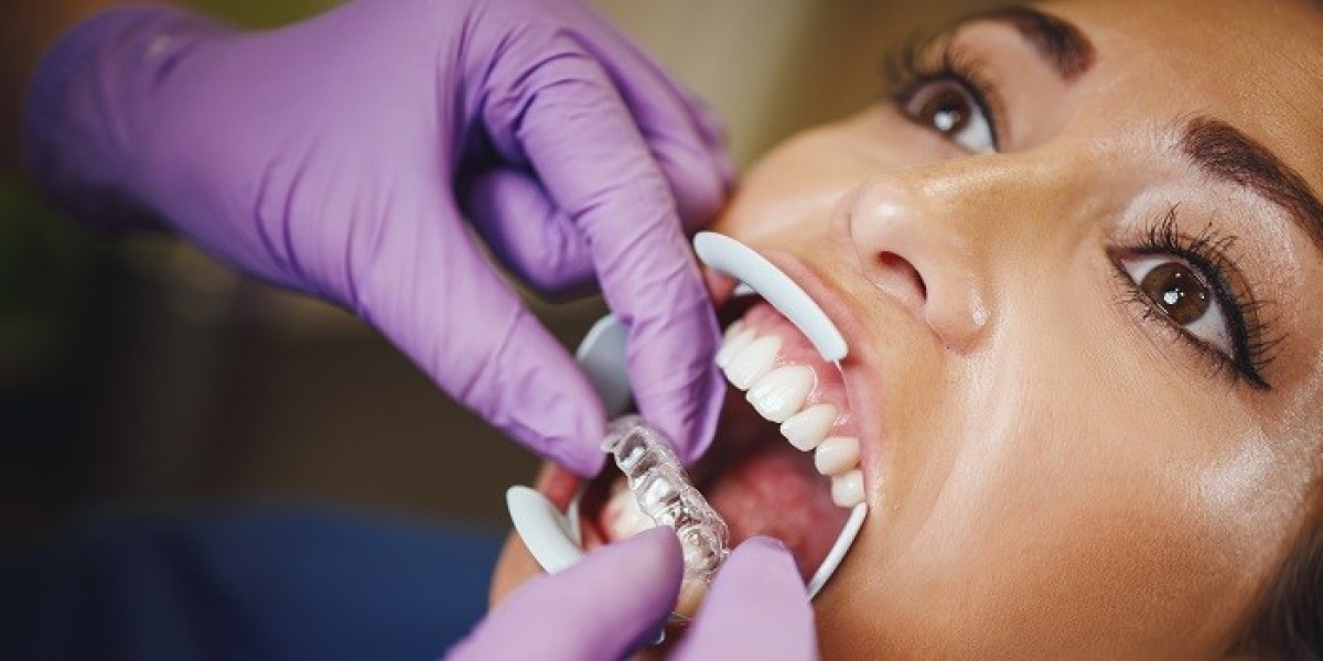 Steps Involved in Root Canal Treatment in Las Vegas